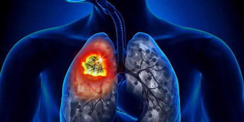 Le gaz de Radon et le cancer du poumon